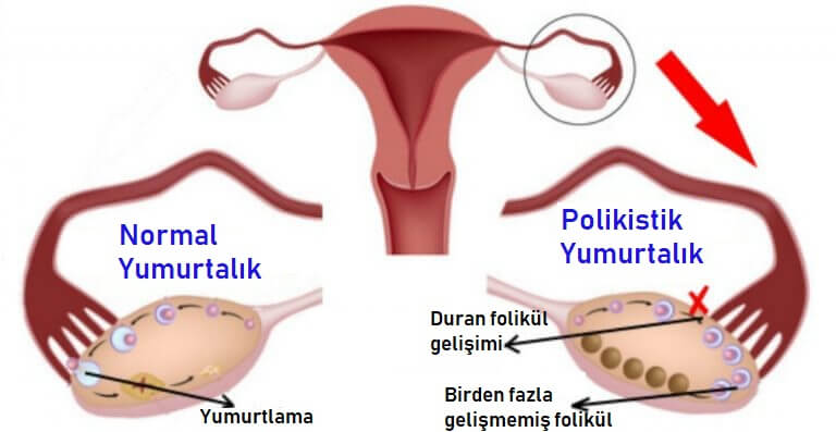 polikistik over sendromu görsel