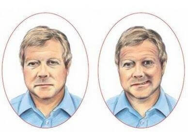 yüz felci nedeniyle asimetri