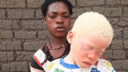 Afrikalı Amerikalı ve albino olan iki çocuk