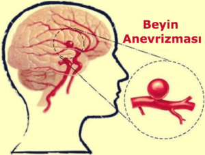 İntrakranyal Anevrizma Nedir?