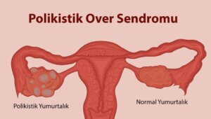 Polikistik Over Sendromu Hakkındaki Her Şeyi Öğrenin