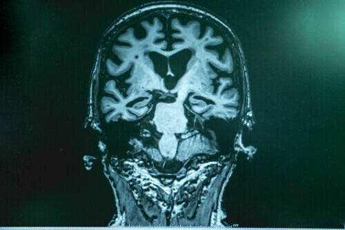 Alzheimer hastalığı beyin
