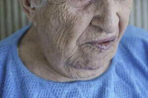 Yüz Felci: Nedenleri ve Tedavi Yöntemleri