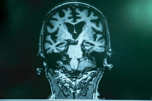 Alzheimer hastalarının beyinlerinde stimülasyon.
