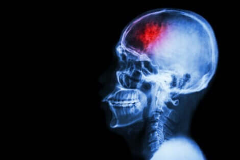 inme sonrası beyin tomografisi