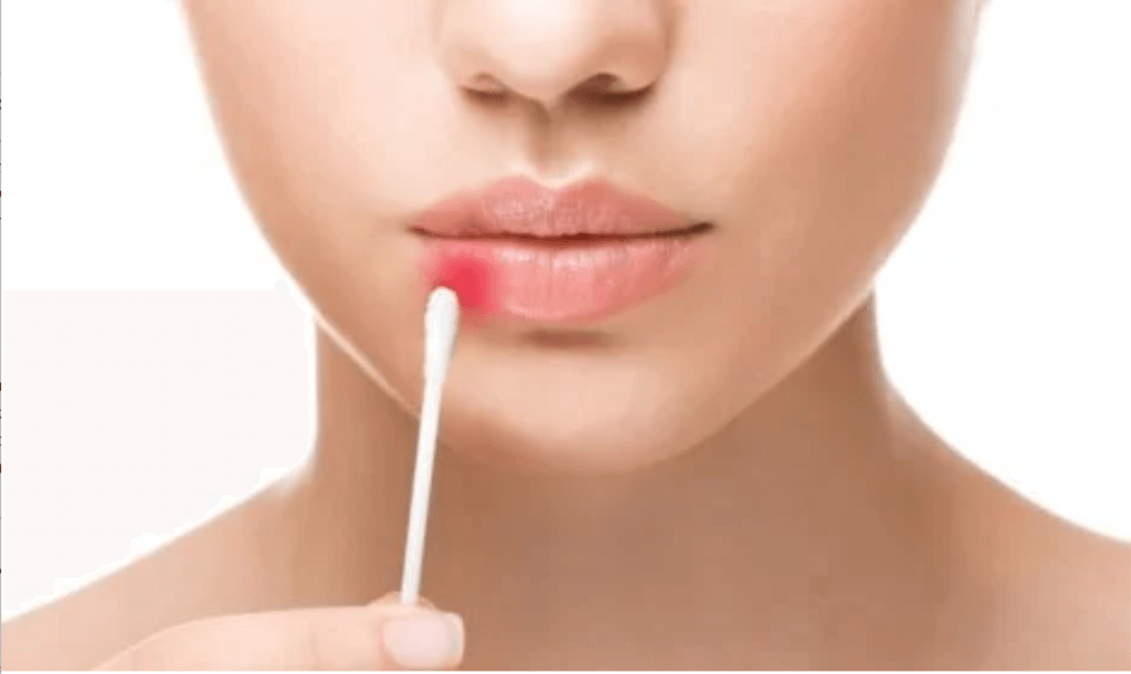 Uçuklar için tedavi yolları.